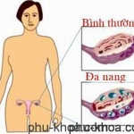 buồng trứng đa nang
