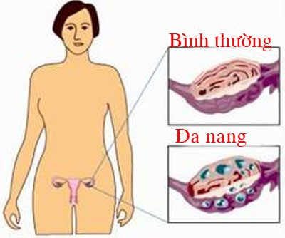 Hình ảnh buồng trứng đa nang