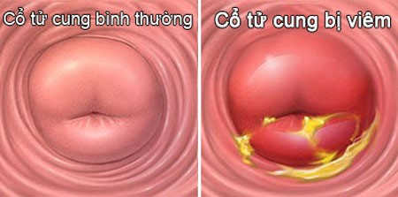 Hình ảnh cổ tử cung bình thường và bị viêm Hình ảnh cổ tử cung bình thường và bị viêm