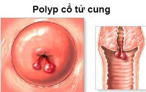 hình ảnh polyp cổ tử cung hình ảnh polyp cổ tử cung