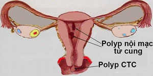 Hình ảnh polyp cổ tử cung Hình ảnh polyp cổ tử cung
