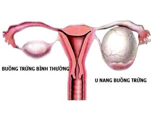 Hình ảnh u nang buồng trứng Hình ảnh u nang buồng trứng