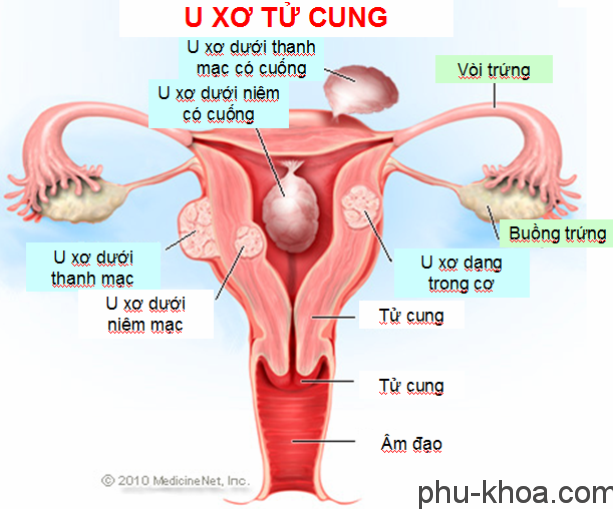 Hình ảnh u xơ tử cung hình ảnh u xơ tử cung