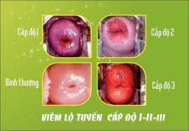 Hình ảnh viêm lộ tuyến cổ tử cung theo cấp độ Hình ảnh viêm lộ tuyến cổ tử cung theo cấp độ