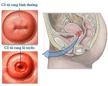 Hình ảnh viêm lộ tuyến cổ tử cung Hình ảnh viêm lộ tuyến cổ tử cung