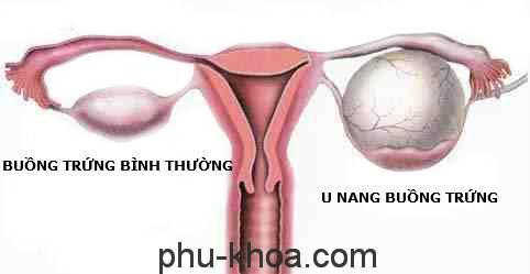 u nang buồng trứng