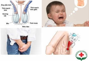 Giãn tĩnh mạch thừng tinh ở trẻ nhỏ