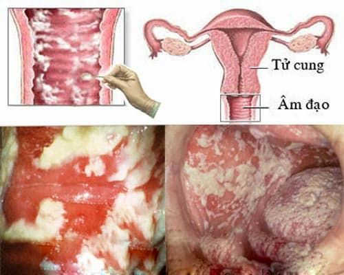 Hình ảnh viêm âm đạo do nấm men 
