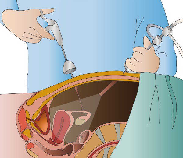 mổ nội soi phá thai ngoài tử cung