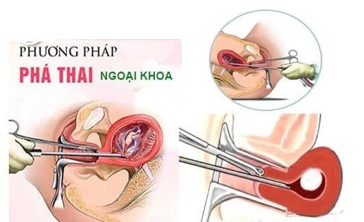 Phương pháp nong gắp thai