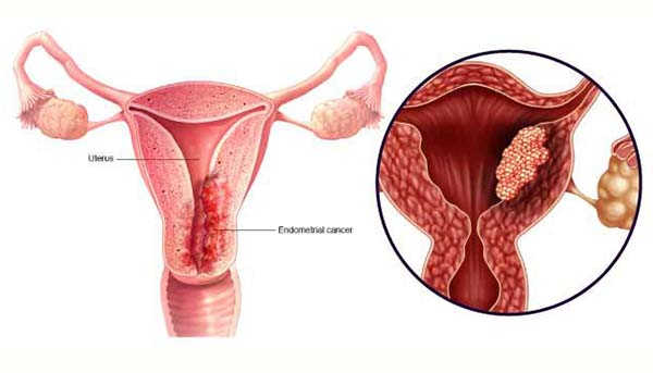 Chlamydia tác nhân gây ung thư cổ tử cung