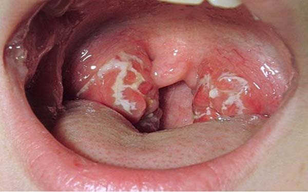 Bệnh lậu ở miệng: Nguyên nhân, triệu chứng, chuẩn đoán và điều trị