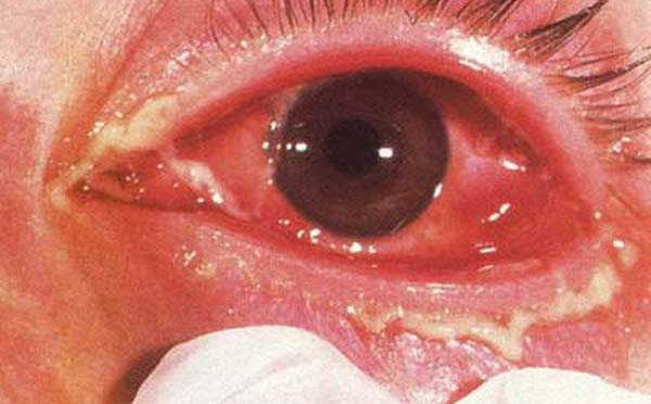 Hình ảnh bệnh lậu ở mắt