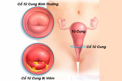 Viêm cổ tử cung có thể gây ngứa vùng kín ở nữ giới
