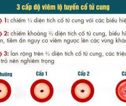 cach-phong-ngua-viem-lo-tuyen