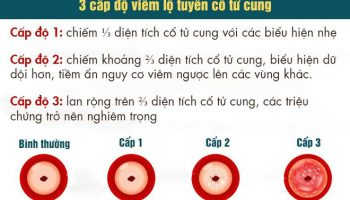 Hướng dẫn cách phòng ngừa viêm lộ tuyến hiệu quả