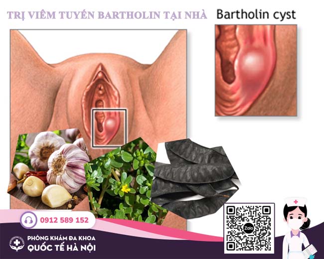 trị viêm tuyến bartholin tại nhà