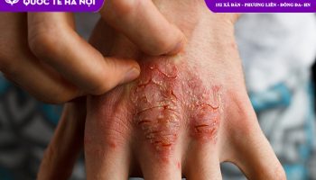 Viêm da cơ địa kiêng gì để bệnh nhanh khỏi không tái phát?