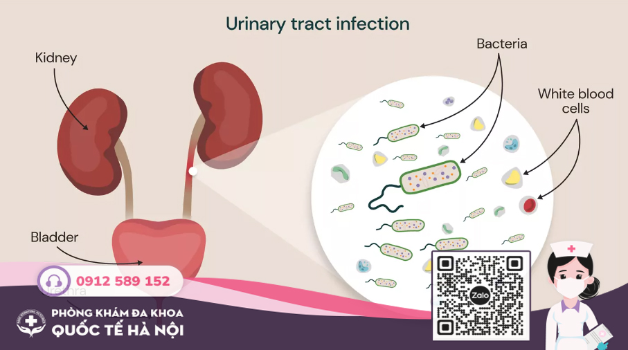nguyên nhân viêm đường tiết niệu