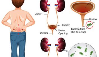 Nguyên nhân viêm đường tiết niệu