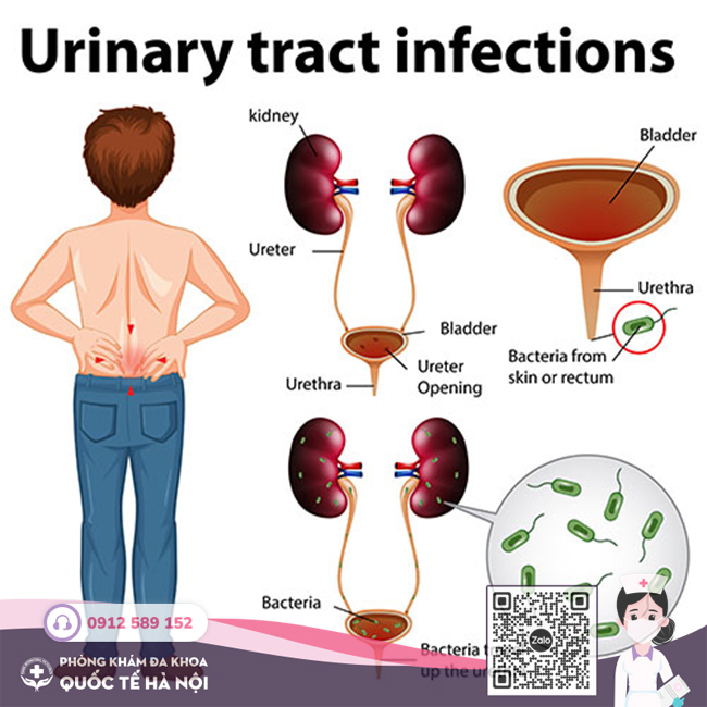 viêm đường tiết niệu nam