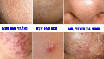 Tổng hợp các hình ảnh mụn trứng cá trực quan nhất