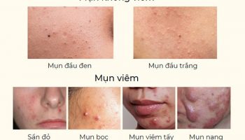 Mụn trứng cá là gì? Các thể bệnh thường gặp của mụn