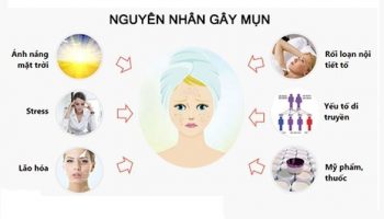Chỉ điểm 8+ nguyên nhân gây mụn trứng cá phổ biến hiện nay