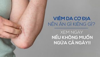 Viêm da dị ứng kiêng ăn gì – ăn gì để bệnh nhanh khỏi?