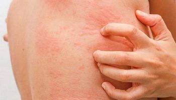 Viêm da cơ địa dị ứng ở người lớn: Dấu hiệu, nguyên nhân, cách điều trị