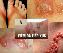 viem-da-tiep-xuc-di-ung