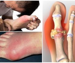benh-gout-theo-y-hoc-co-truyen