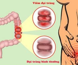 viem-dai-trang-theo-y-hoc-co-truyen