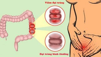 Viêm đại tràng theo y học cổ truyền: Nguyên nhân, triệu chứng, cách điều trị hiệu quả
