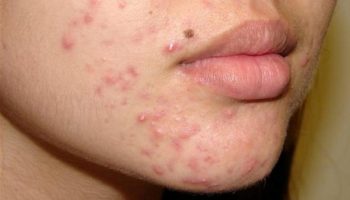 Mụn trứng cá ở đâu trên cơ thể?