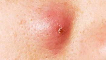 Nổi mụn cục cứng dưới da là vì sao?