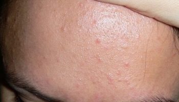 Mụn sẩn: Nguyên nhân, dấu hiệu & cách điều trị hiệu quả nhất