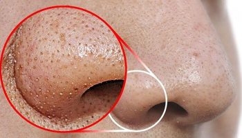 Cách nhận biết mụn trứng cá cực kỳ đơn giản