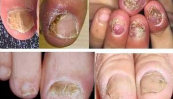 Nấm tay chân là bệnh gì? Nguyên nhân gây nấm tay chân