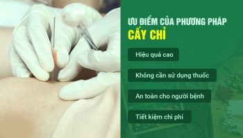 Cấy chỉ bệnh viện Y học cổ truyền – Giải pháp điều trị Đông Tây kết hợp hiệu quả