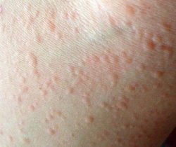 di-ung-thoi-tiet-co-chua-khoi-duoc-khong