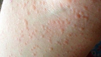 Dị ứng thời tiết có chữa khỏi được không?