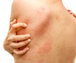 can-trong-voi-bieu-hien-di-ung-thuc-pham