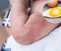 hoi-dap-tre-bi-di-ung-trung-co-tu-het-khi-lon-len-khong