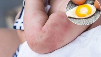 [HỎI ĐÁP] TRẺ BỊ DỊ ỨNG TRỨNG CÓ TỰ HẾT KHI LỚN LÊN KHÔNG?