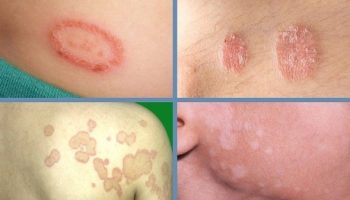 NẤM DA: HIỂU ĐÚNG ĐỂ ĐIỀU TRỊ DỨT ĐIỂM KHÔNG LO TÁI PHÁT