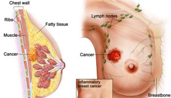 NỔI HẠCH Ở VÚ KHI ĐANG NUÔI CON CÓ SAO KHÔNG?