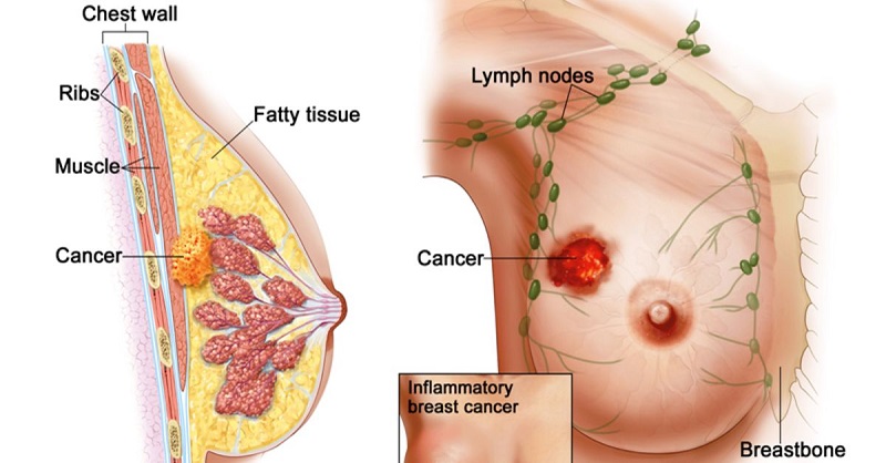 Nổi hạch ở vú khi đang nuôi con có sao không?