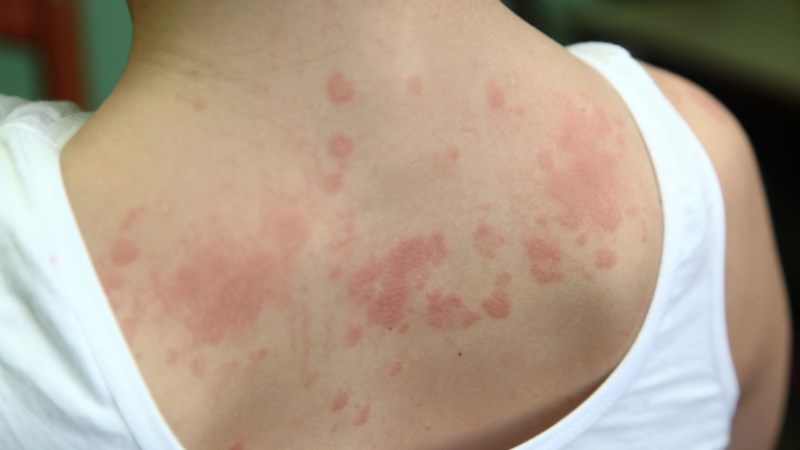 Nổi mẩn, phát ban khi bị dị ứng