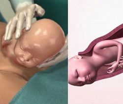 giai-dap-nen-sinh-thuong-hay-sinh-mo